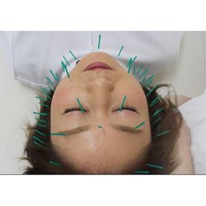 はじめての美容鍼体験チケット