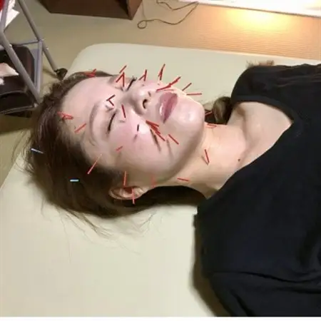 【話題】お試し美容鍼/はりフェイスケア体験チケット_旅行券・チケット  体験チケット _【1270163】