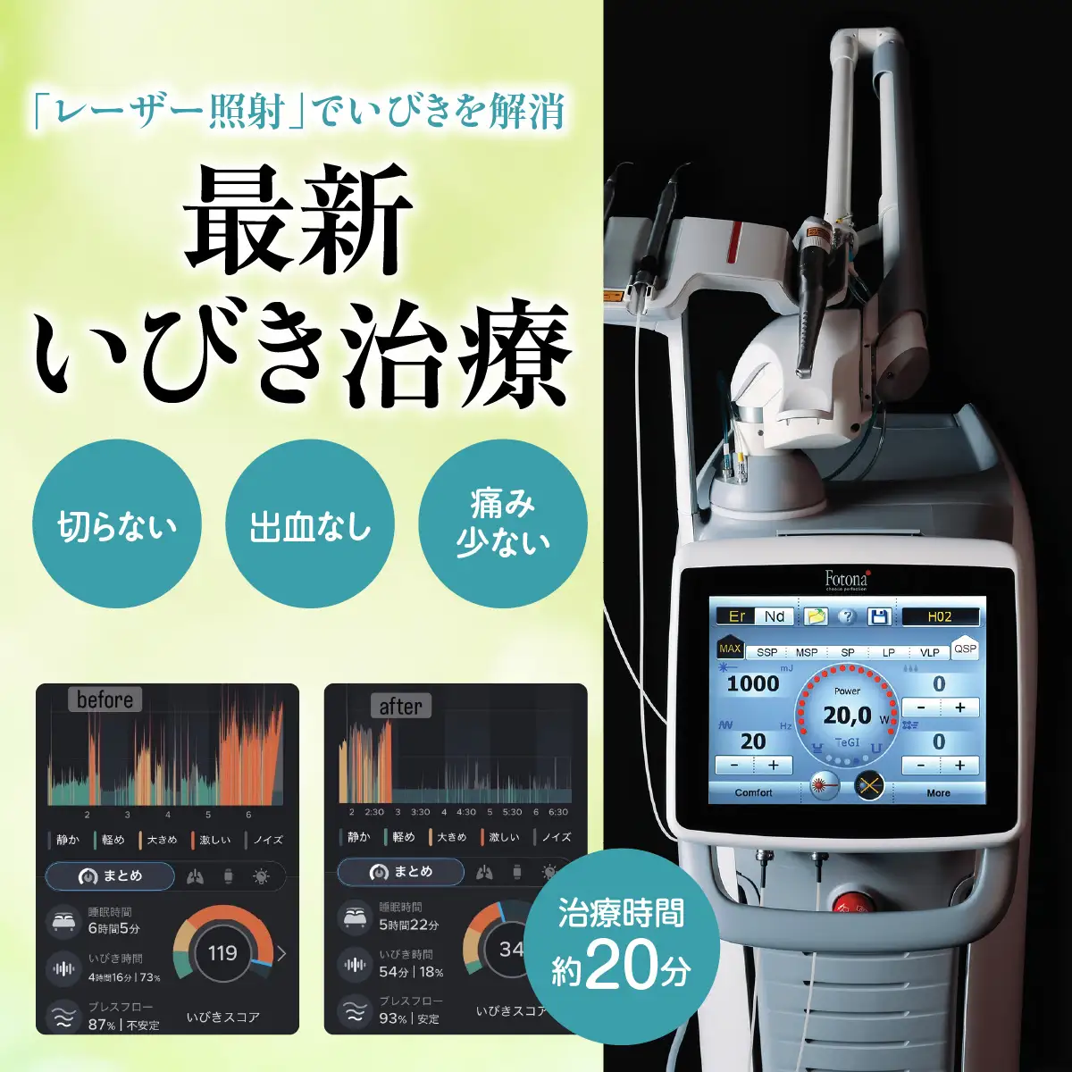いびき治療利用券（５回） ANBV003