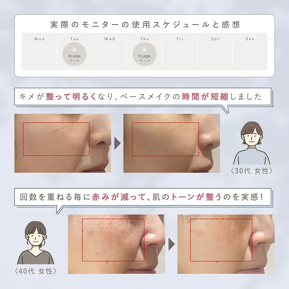LINKA スノー フラッシュ（DPL_NIR 光美容器）
