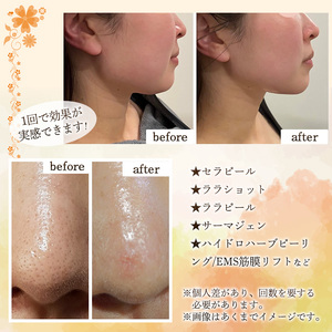 ＜数量限定＞フェイシャルエステ利用券(30,000円分(3,000円×10枚分)/フェイシャルエステプラン全メニューに使用可) ハーブピーリング ララピール ニキビ 小顔リフトアップ 美容 サロン レディース チケット 体験 【m66-14】【melty minoh】