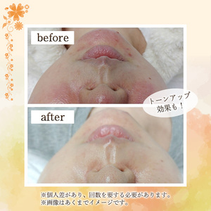 ＜数量限定＞水光肌LHAララピール利用券(1枚) ララピール LHAララピール 韓流女優肌 水光肌 韓国発 毛穴ケア ニキビケア 美白ケア 角質ケア 美容 フェイシャル サロン エステ レディース チケット 体験 【m66-16】【melty minoh】