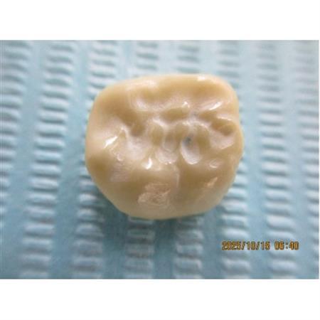 ジルコニアの1回治療(2年無料・7年有料保証付き)