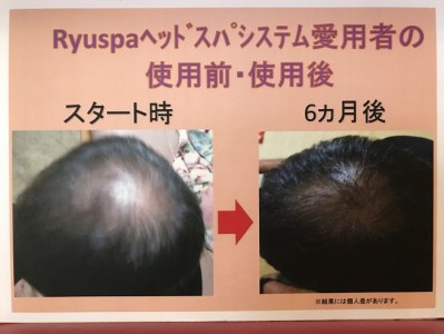 ポイントピュール 自宅でできるヘッドスパ 4点セット 沖縄県久米島町 ふるさと納税サイト ふるなび