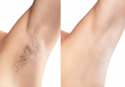 【メンズ脱毛】全身脱毛※VIO全顔付き _FL03