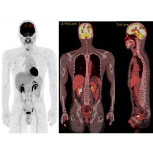 佐久医療センター　PET/CTがん検診