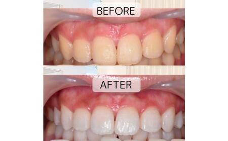 【ご来院必須】ホームホワイトニング券 　自宅で手軽に歯のホワイトニングを楽しめます